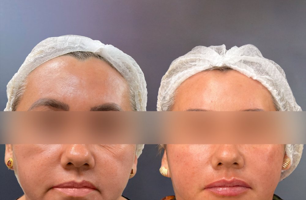 Antes e depois, Preenchimento facial, malar e mandíbula